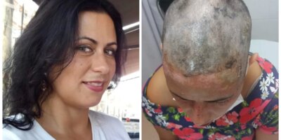 La femme a attaqué avec de la soude caustique, il y a un mois: "J'ai fait quatre plaintes aux Mossos, ils ne le résolvent pas"