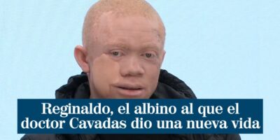 Reginaldo, l&rsquo;albinos noir à qui le docteur Cavadas a redonné vie
